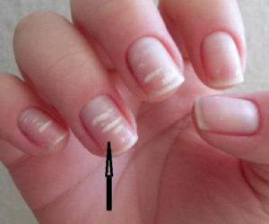 Белые полоски на ногтях: Что означают, причины появления и способы лечения