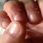 Заусенцы на пальцах: причины появления, лечение, удаление, профилактика
