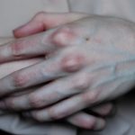 Руки постоянно холодные: почему? Причины и факторы, которые влияют на терморегуляцию конечностей