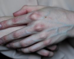 Руки постоянно холодные: почему? Причины и факторы, которые влияют на терморегуляцию конечностей