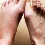 Почему отекают ноги: причины и как снять отек