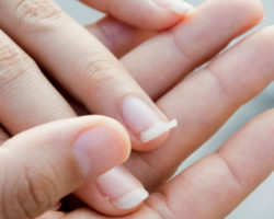 Постоянно ломаются ногти: почему и что делать. Каких витаминов не хватает в организме?